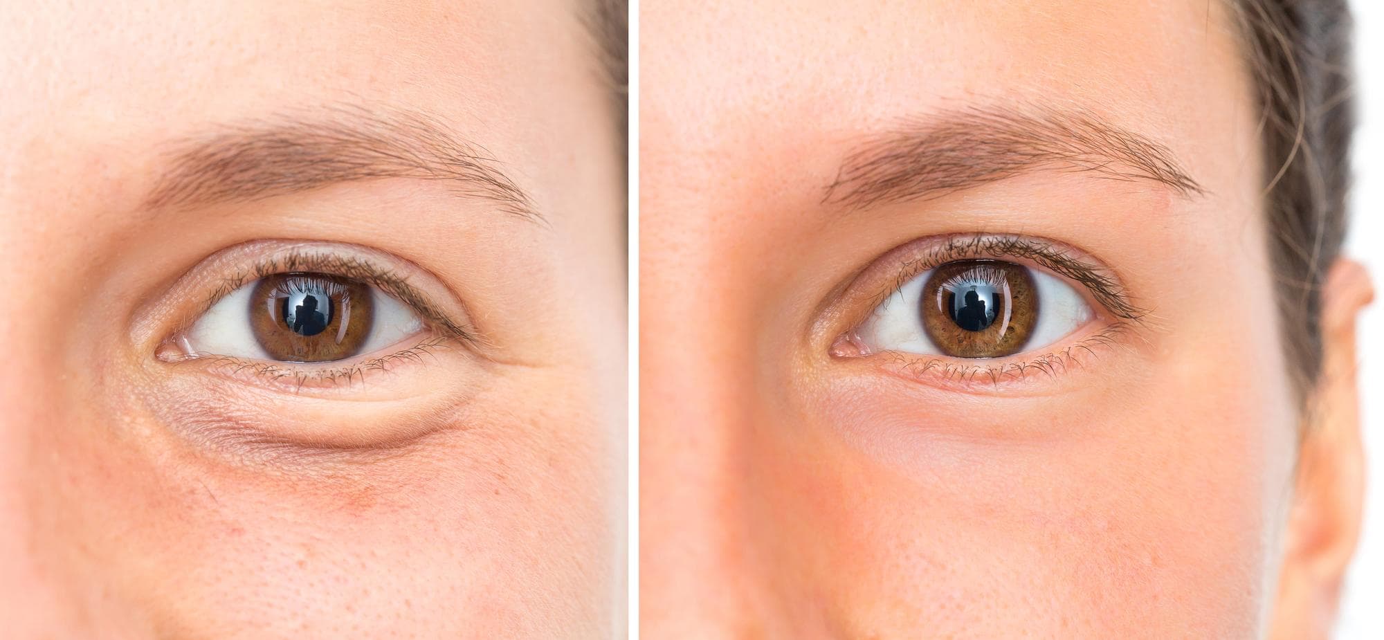 Blepharoplasty before and after