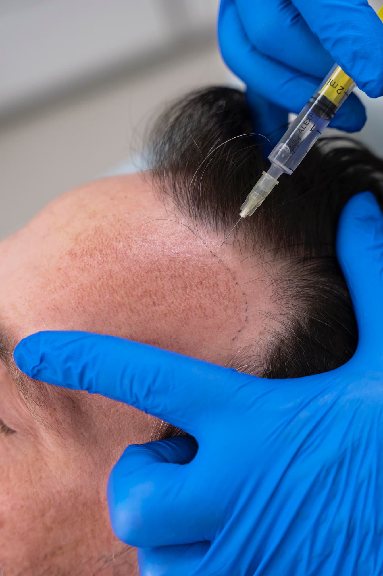 Hair restoration treatment