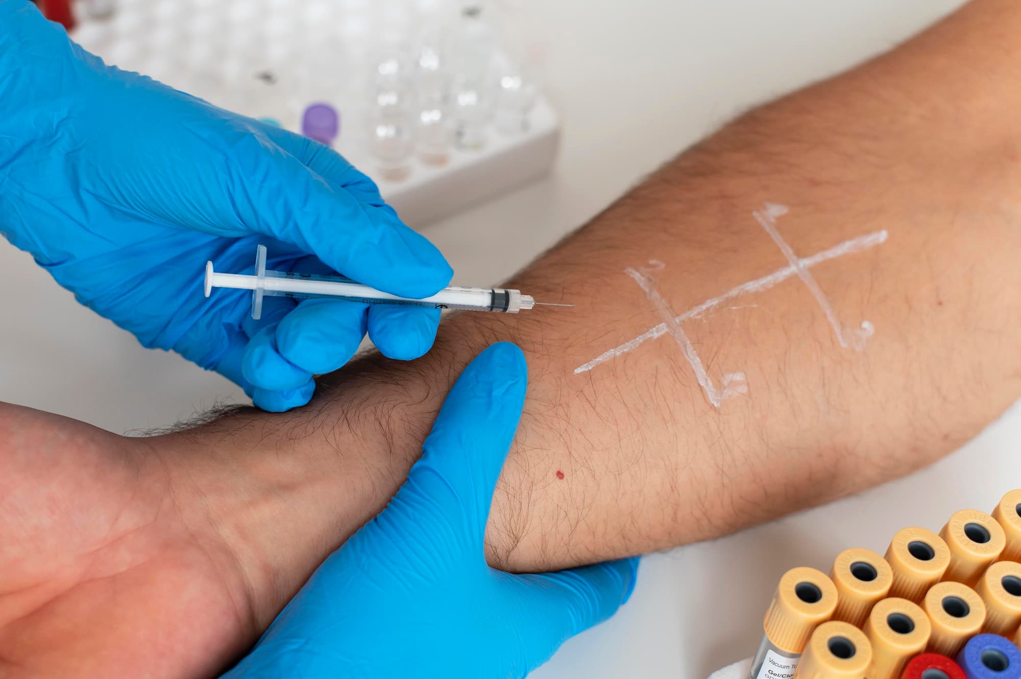 Varicose vein treatment